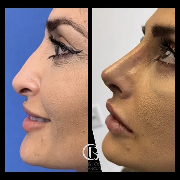 Img-DrCarlosBetancur-Antes&Despues-2025-Rinoplastia-1