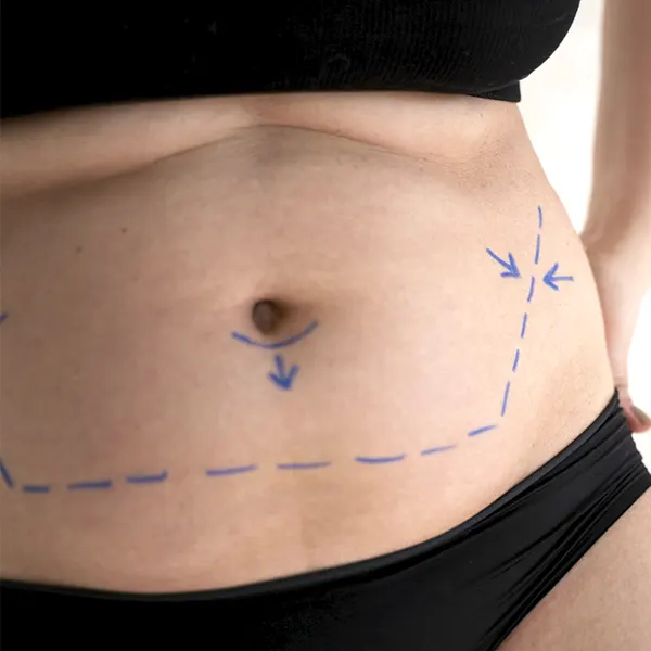 Img-cirujano-plastico-medellin-Abdominoplastia-2025