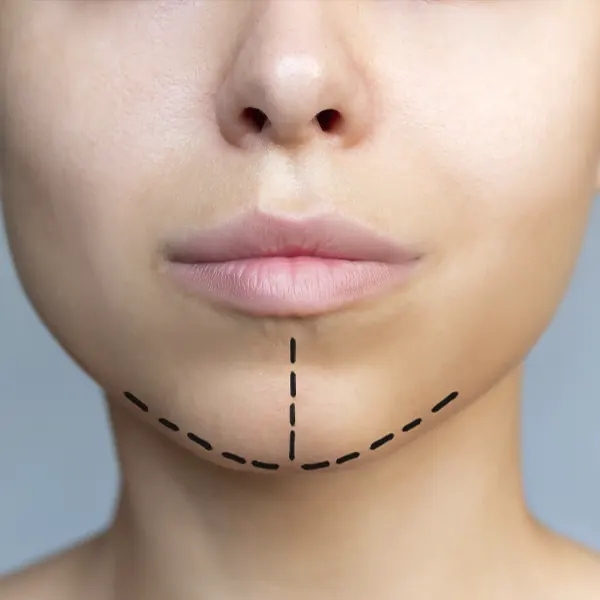 Img-cirujano-plastico-medellin-CirugiaDeMenton