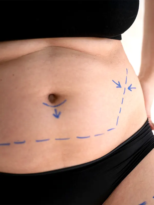 img-abdominoplastia-medellin-1